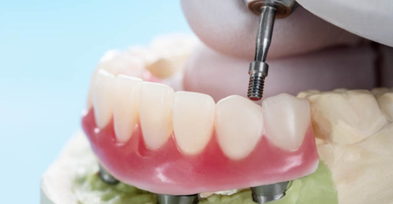 Removable Dentures - Dr. Varshney’s DENTOCARE